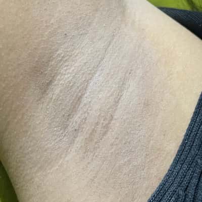 Underarms - Diah Sri Mas Iswari